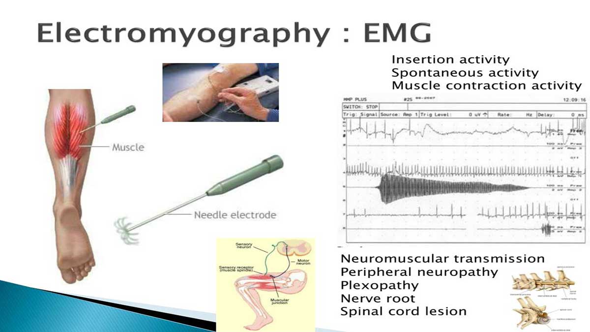 فرایند نوار عصب و عضله بدن (EMG)