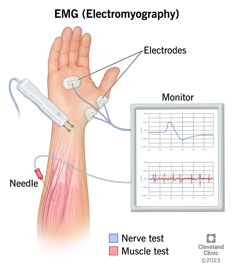 مراحل نوار عصب دست (عصب تونل کارپال) که توسط الکترود ها و سوزن تغییرات اعصاب و عضله را مانیتور میکند.