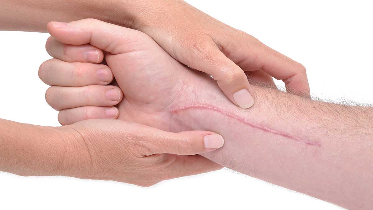 علائم نیاز به نوار عصب دست