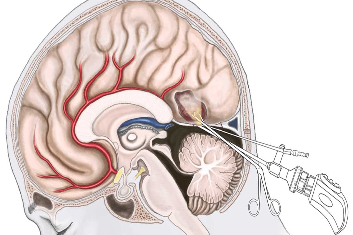 تشخیص بیماریهای مختلف مغز و اعصاب 