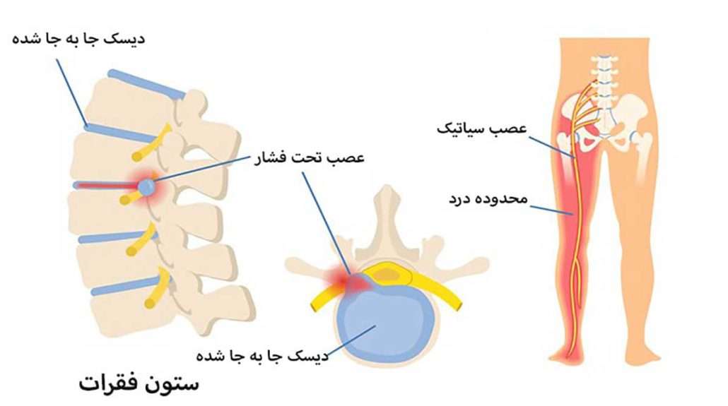 نوار عصب سیاتیک