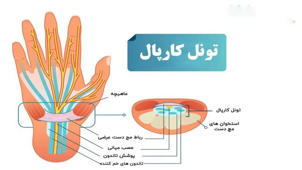 تصویر کامل از نمای تونل کارپال