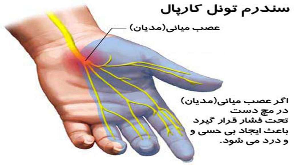 دلایل ابتلا به عمل سندروم تونل کارپال 