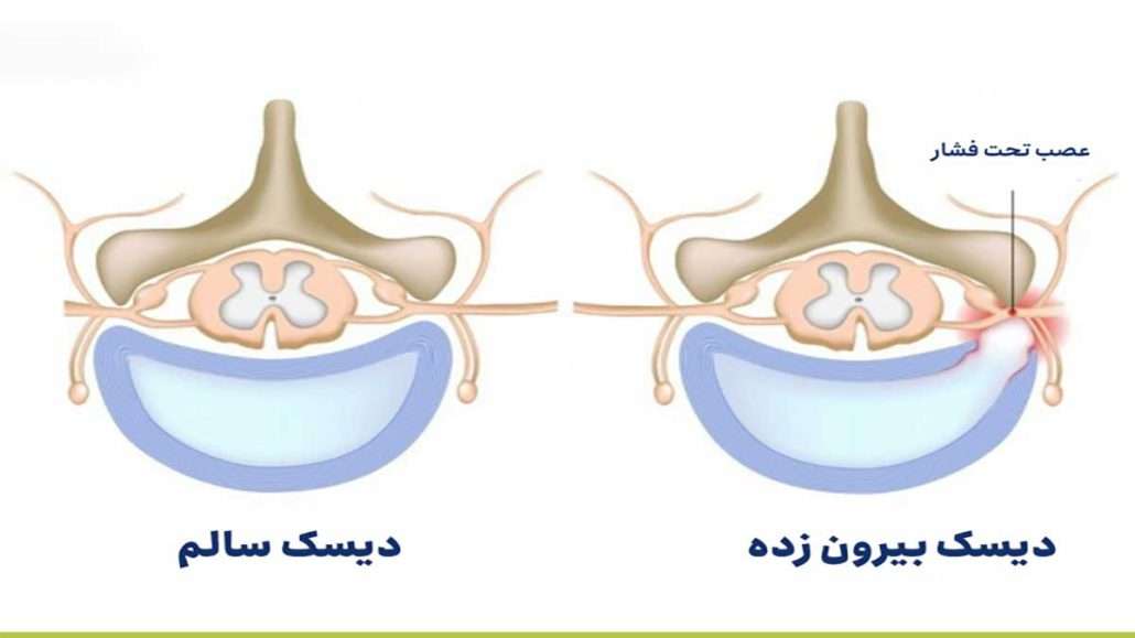 تفاوت دیسک سالم و دیسک بیرون زده