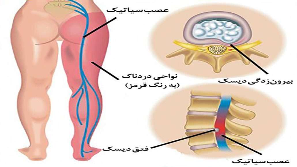 درد سیاتیک