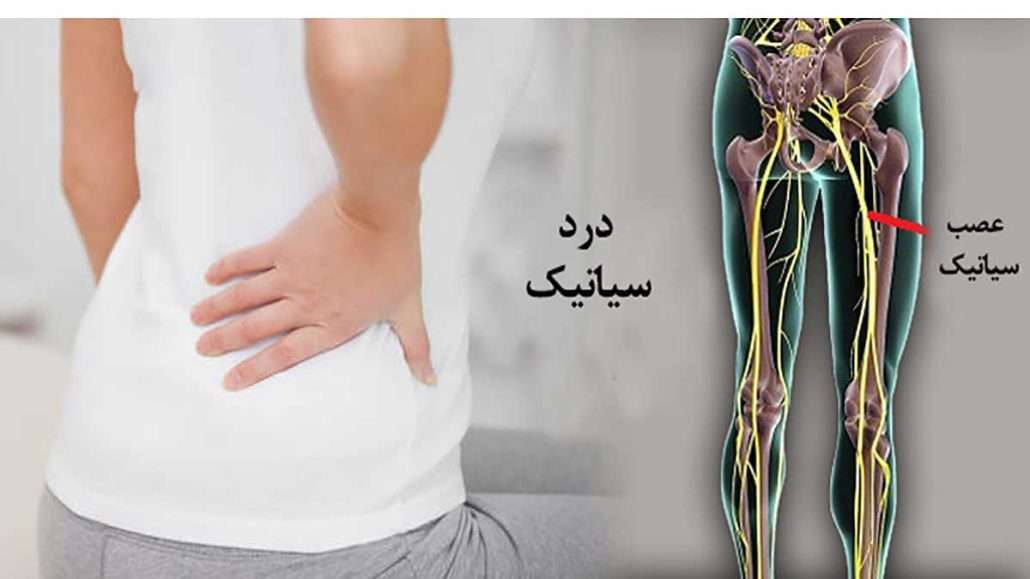 تست نوار عصب سیاتیک در تهران