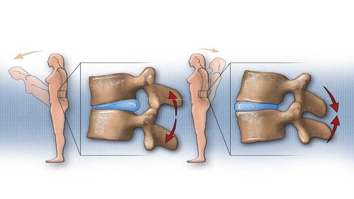 سیاتیک بارداری