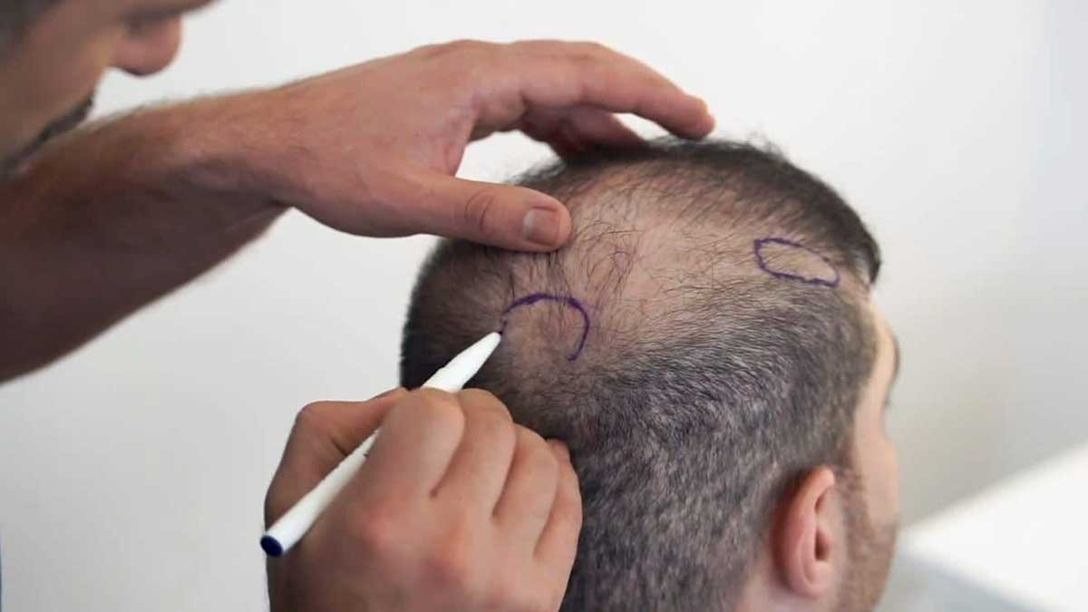 تاثیر پی آر پی بر ریزش موی ارثی