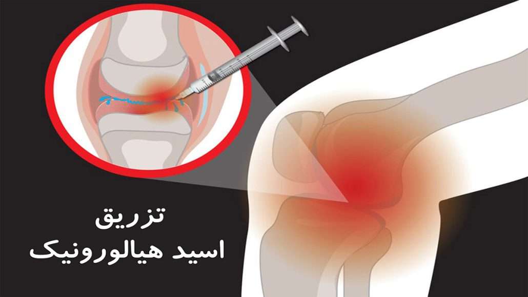 تزریق داخل مفصلی زانو
