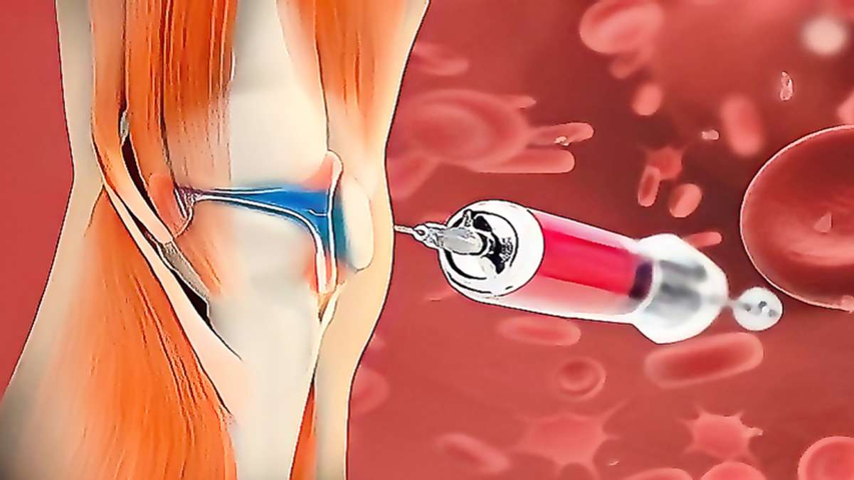 نمایی از زانو که آمپول در آن تزریق می شود