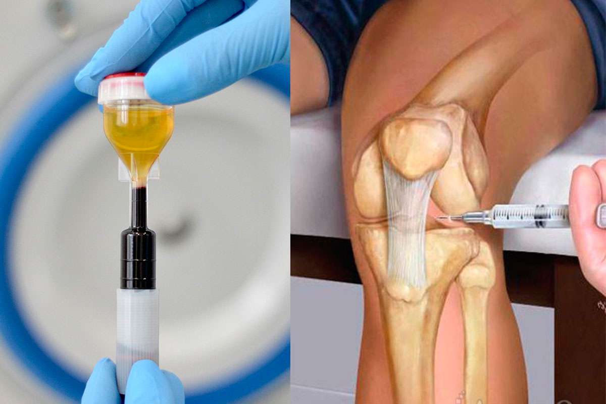 ژل هیالورونیک اسید برای زانو در داروخانه 
