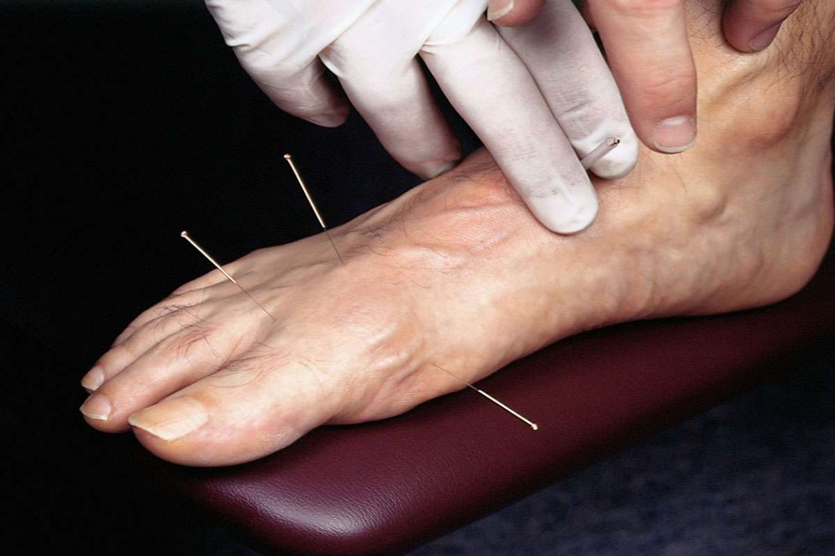 درمان میخچه پا با طب سوزنی