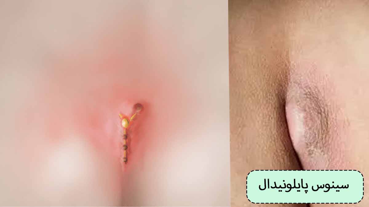 خطرات کیست مویی در پایین کمر