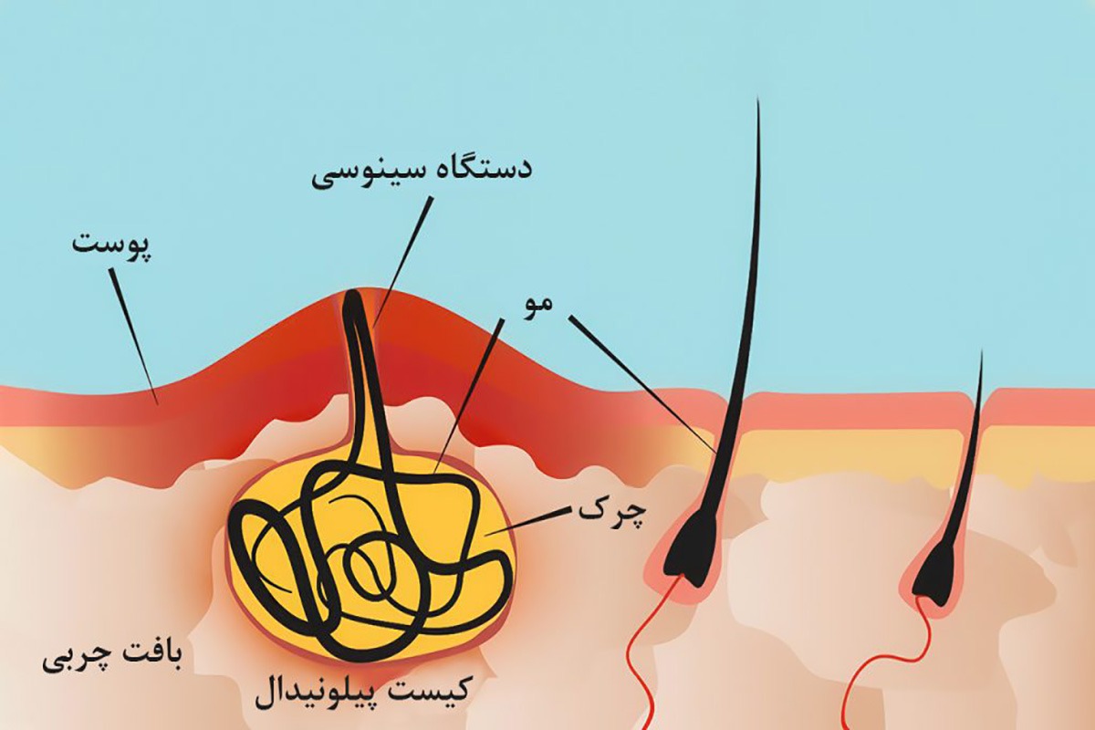  درمان کیست مویی کمر