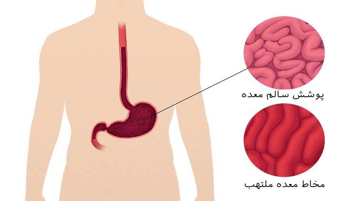 عکس آندوسکوپی معده سالم