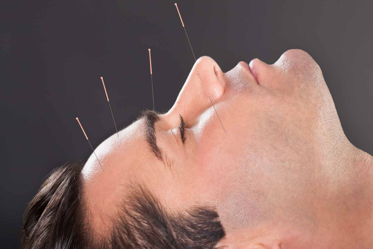 طب سوزن برای صورت