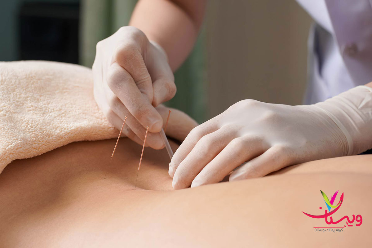 فاصله بین جلسات طب سوزنی