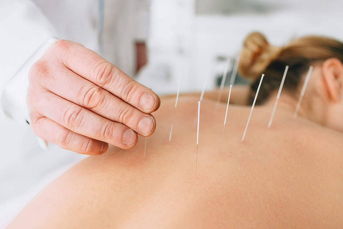 طب سوزنی برای دیسک کمر