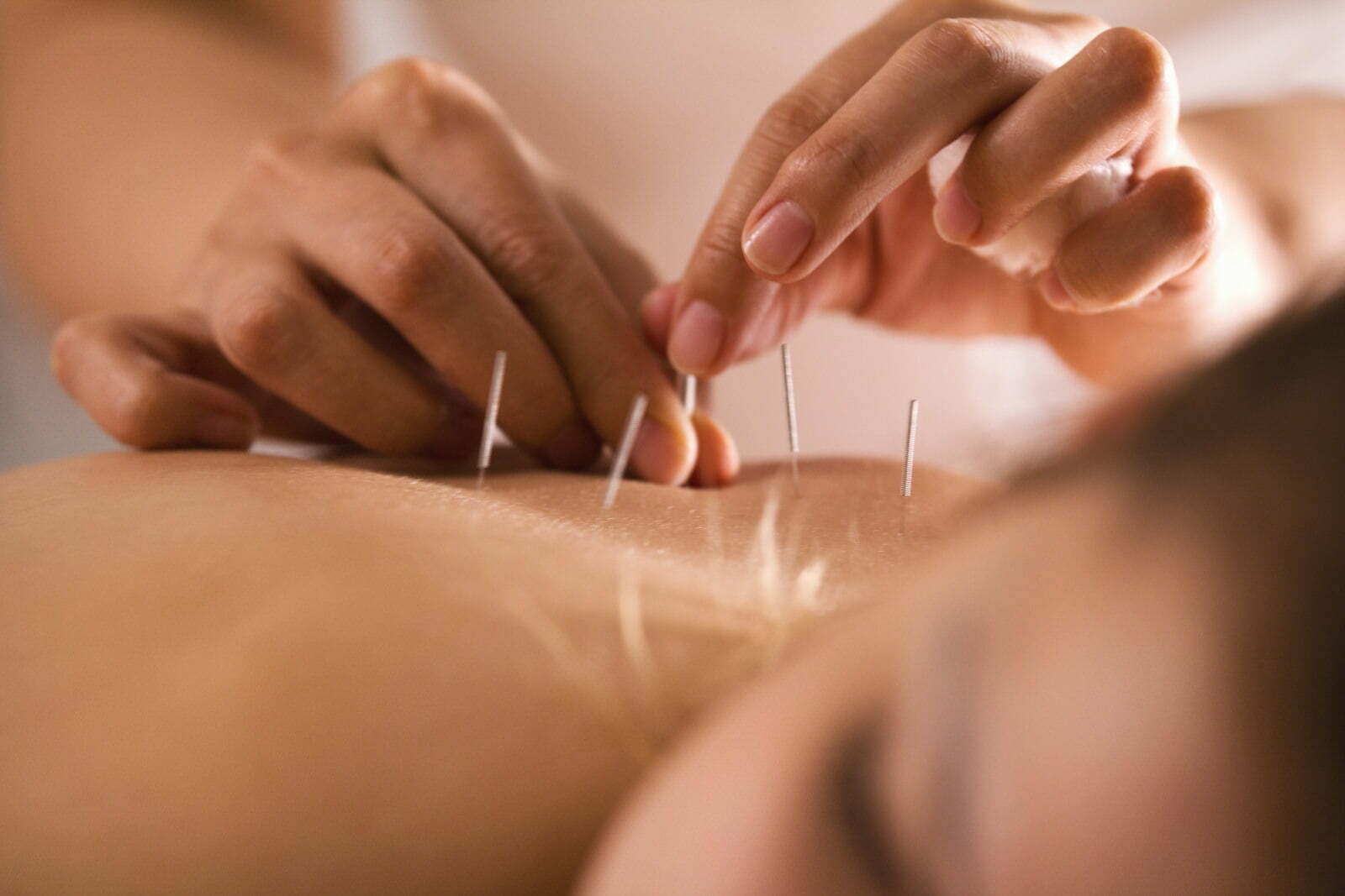 مراقبت قبل از طب سوزنی