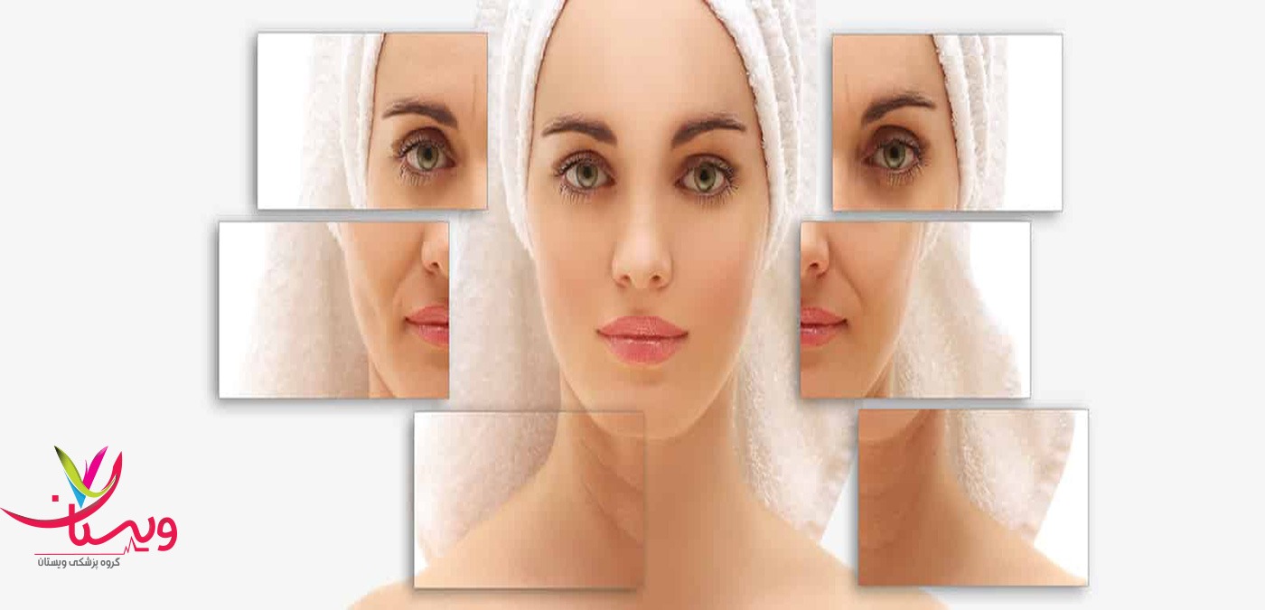 نقاط تزریق بوتاکس میگرن
