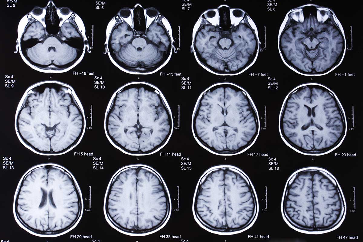 MRI مغز که نشان دهنده تومور مغزی است