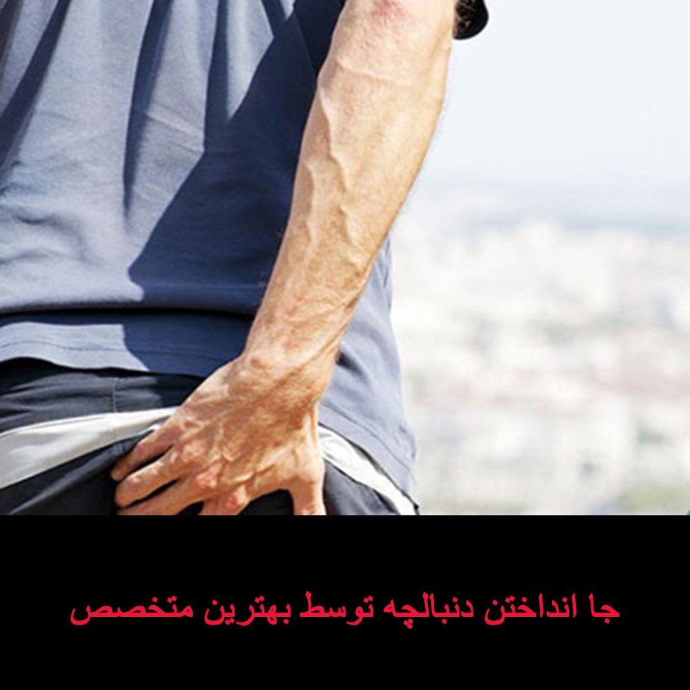 روشهای جا انداختن دنبالچه