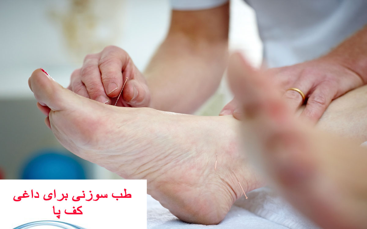 طب سوزنی برای داغی کف پا