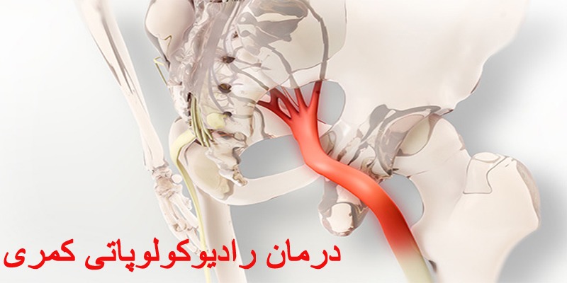درمان رادیوکولوپاتی کمری