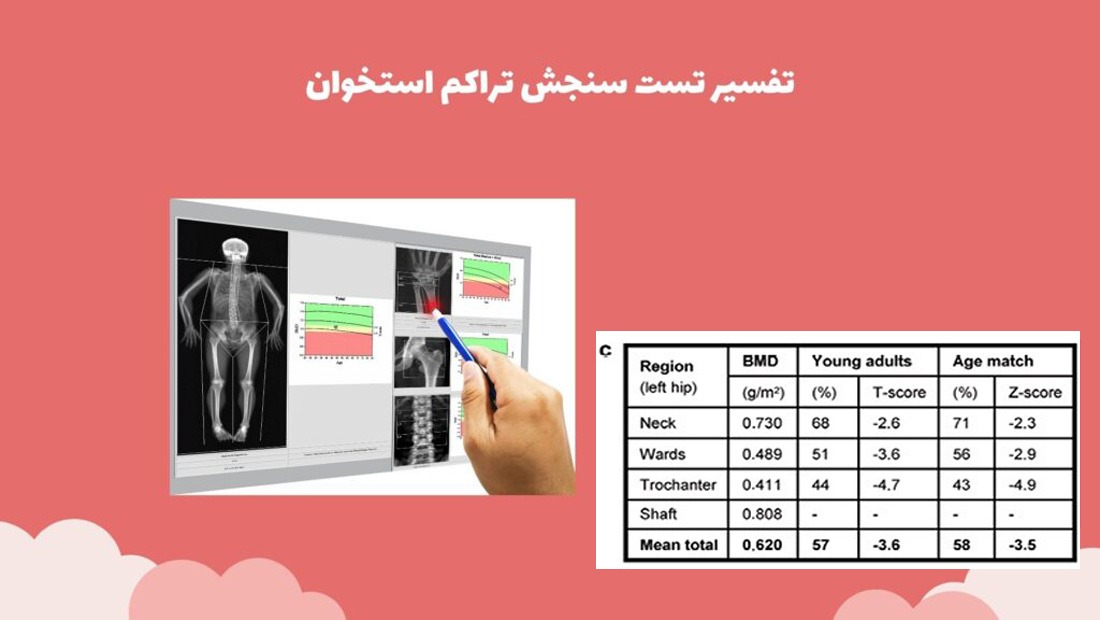 تفسیر جواب آزمایش تراکم استخوان