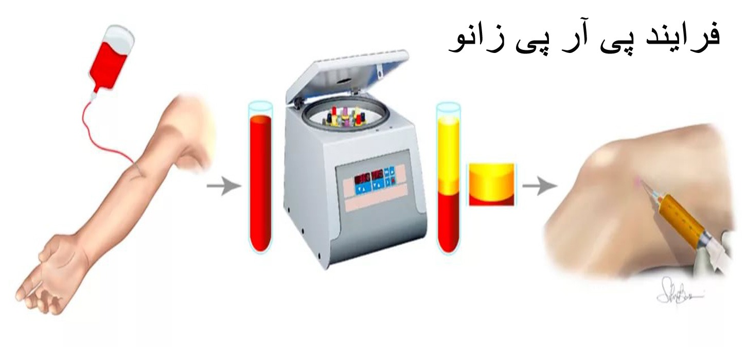 بهترین مرکز پی آر پی زانو در تهرانسر