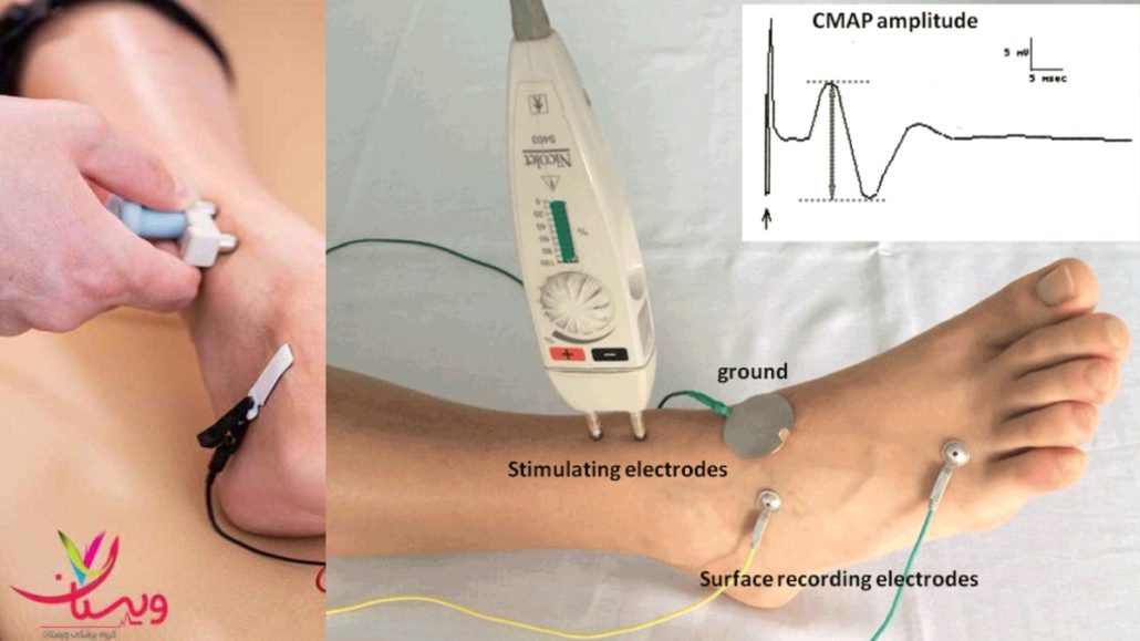 بیمار در حال انجام تست نوار عصب عضله پا به همراه نمودار cmap amplitude 