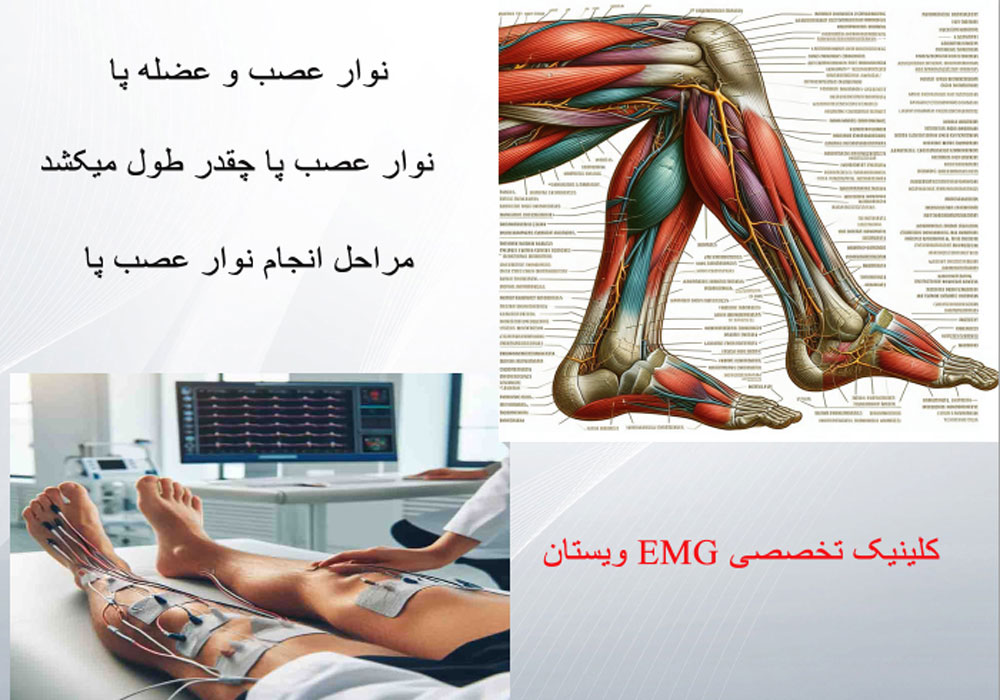 نوار عصب پا چقدر طول میکشد 