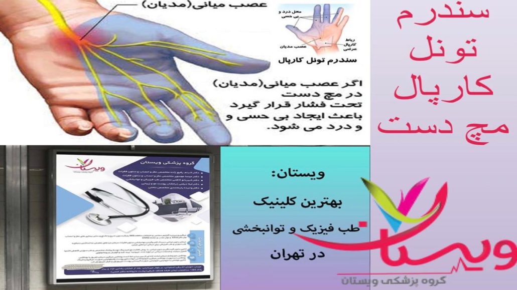 سندرم تونل کارپال مچ دست