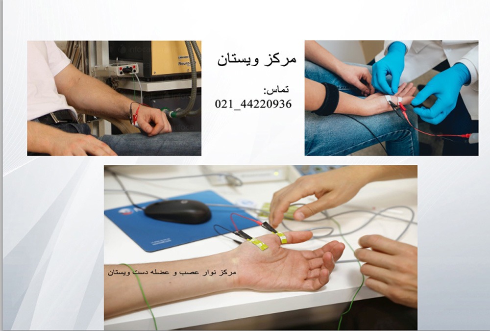 نوار عصب دست کجا بگیریم