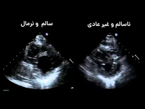 عکس اکو قلب ناسالم