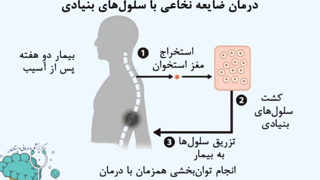 مراحل درمان ضایعه نخاعی با تزریق سلول بنیادی