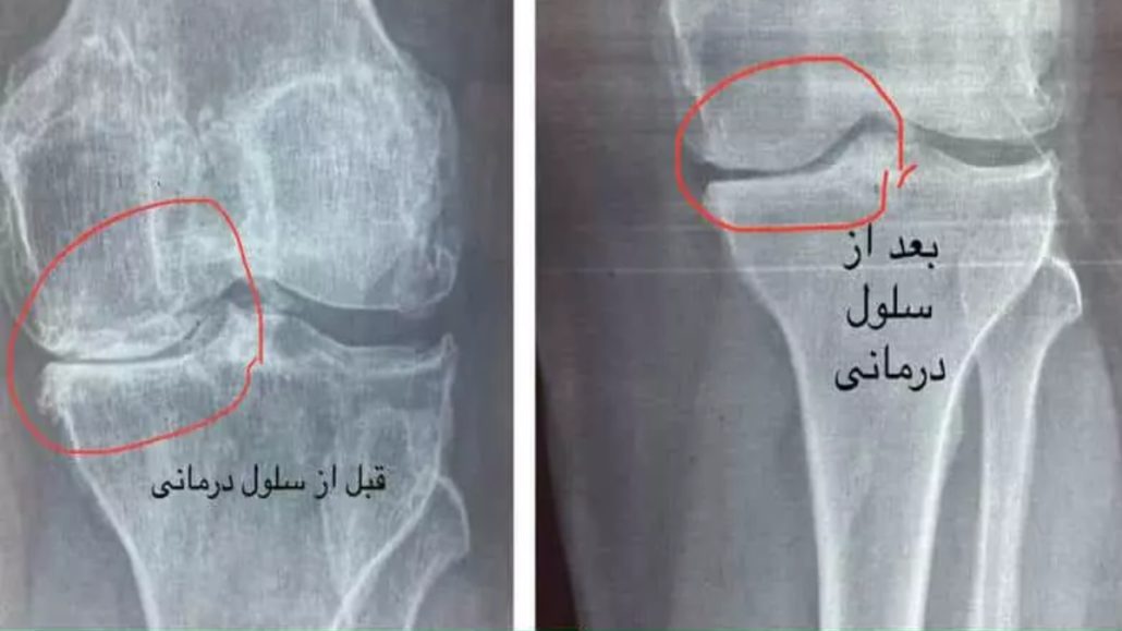 عکس قبل و بعد تزریق سلول بنیادی به زانو