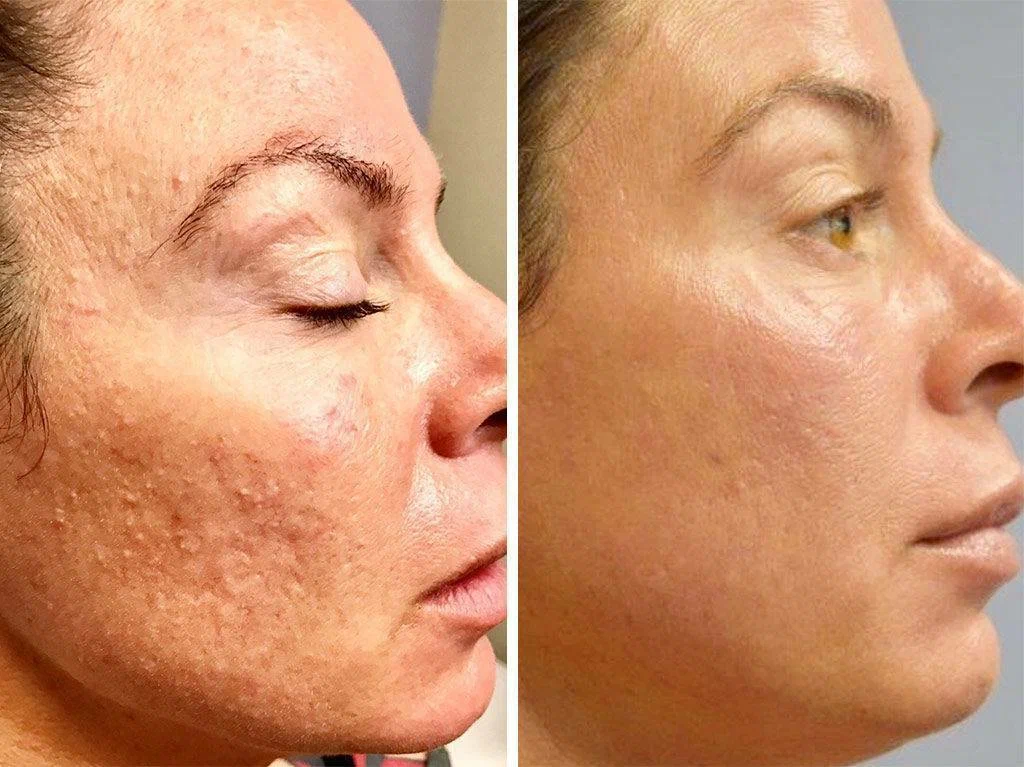 عوارض prp صورت برای درمان جای جوش 