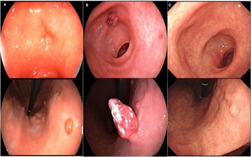 میکروب معده خطرناک است