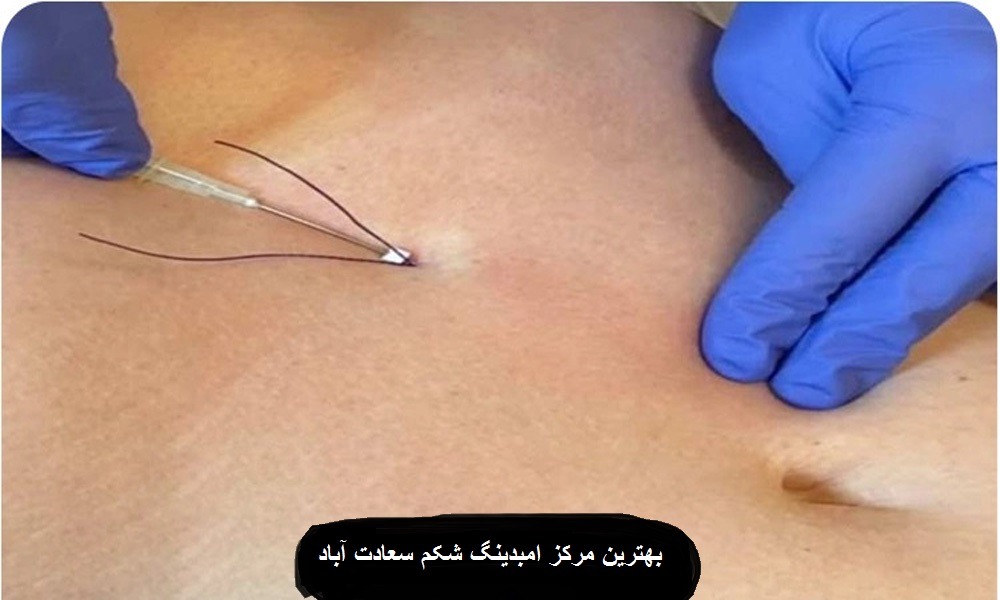 بهترین مرکز امبدینگ شکم در سعادت آباد