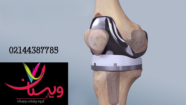 ایا عمل تعویض مفصل زانو خطرناک است