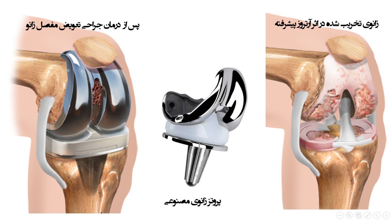 عکس تعویض مفصل زانو