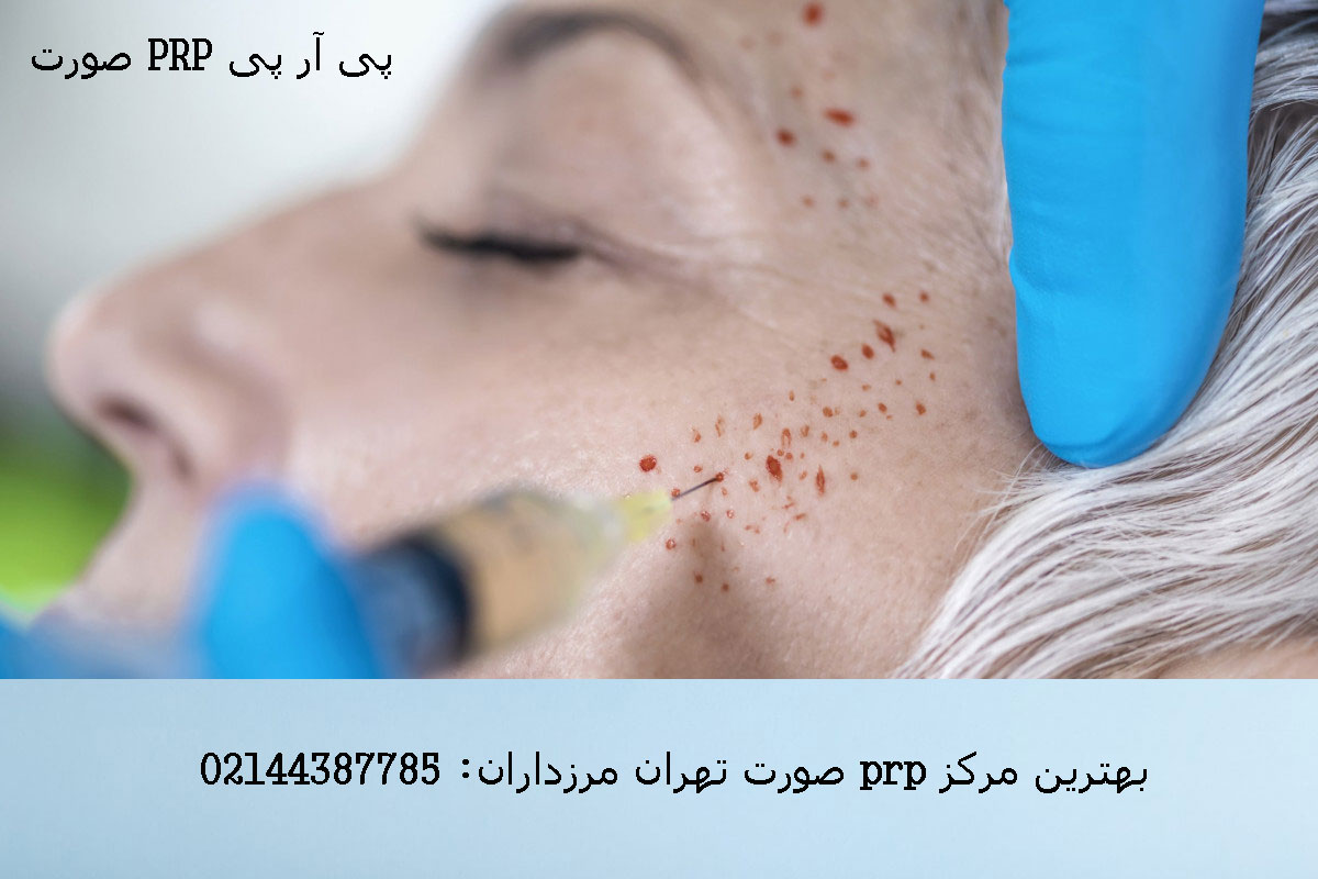 ماندگاری پی آر پی صورت