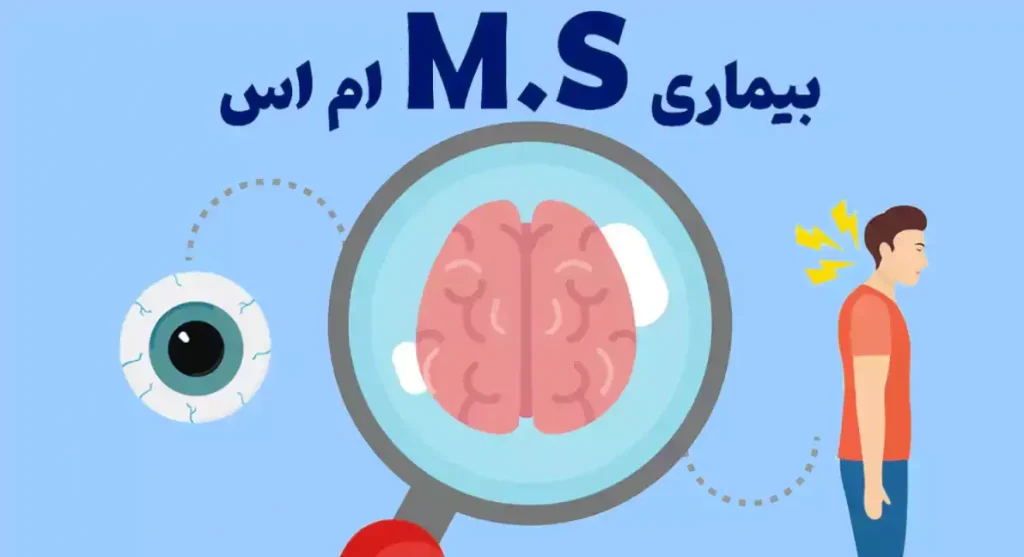 مقدار مصرف کورتون برای بیماران ام اس