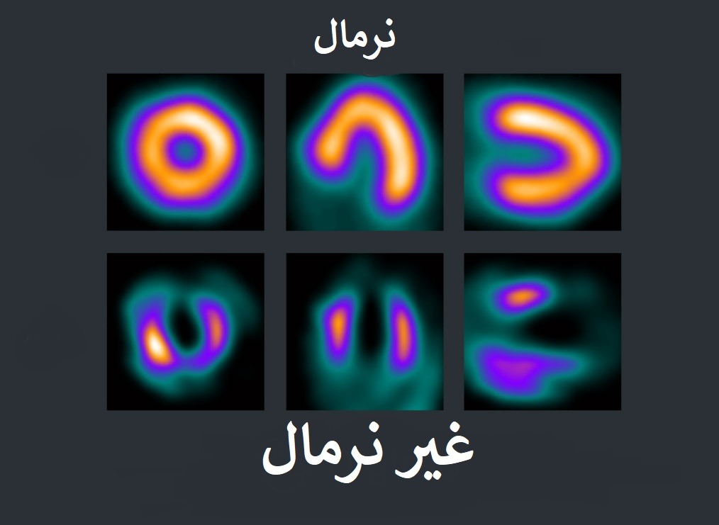 عکس اسکن قلب اسکن هسته ای قلب نرمال و غیرنرمال