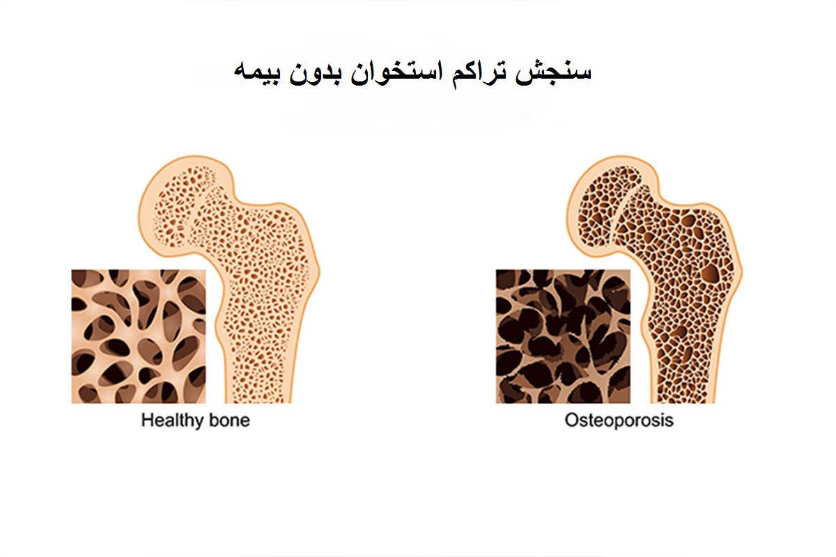 مقایسه استخوان مبتلا به پوکی با استخوان سالم