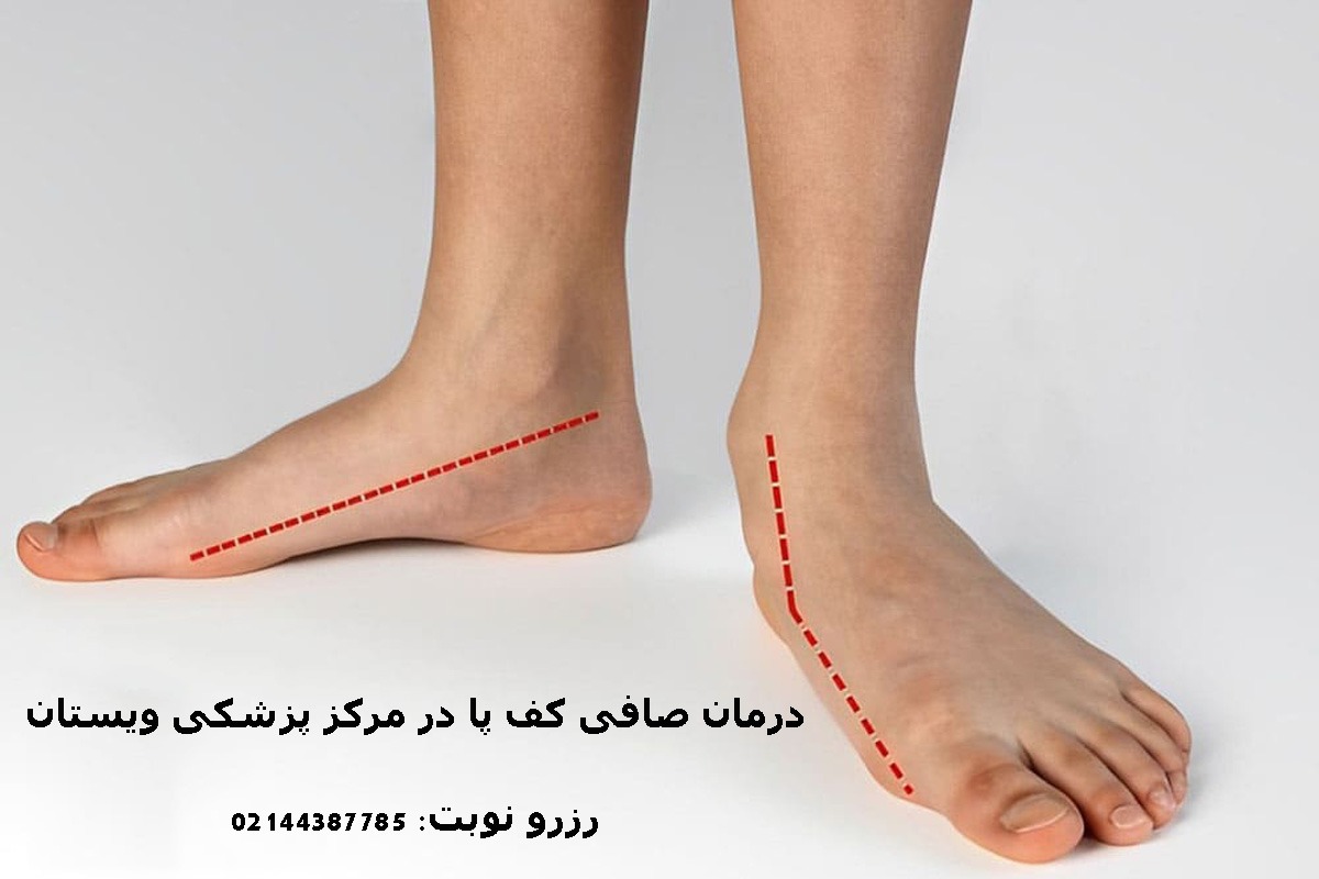 مراکز درمان صافی کف پا در تهران