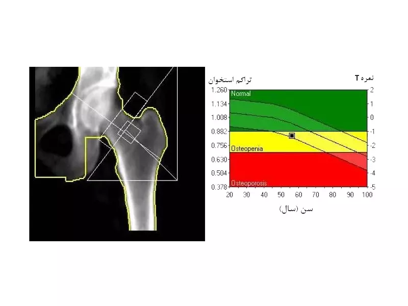 اسم آزمایش پوکی استخوان