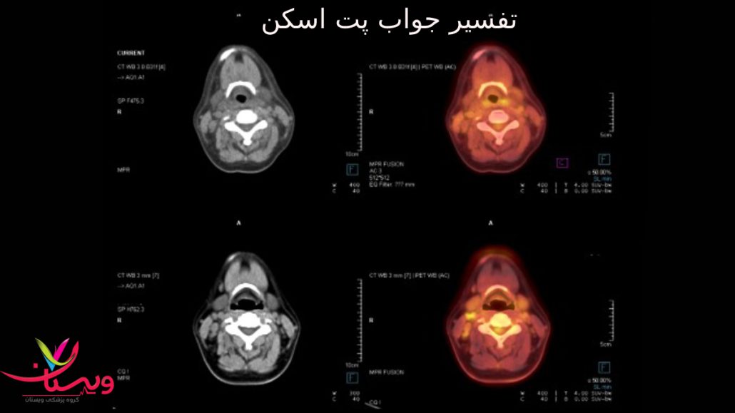 تفسیر جواب پت اسکن - عکس پت اسکن مغز