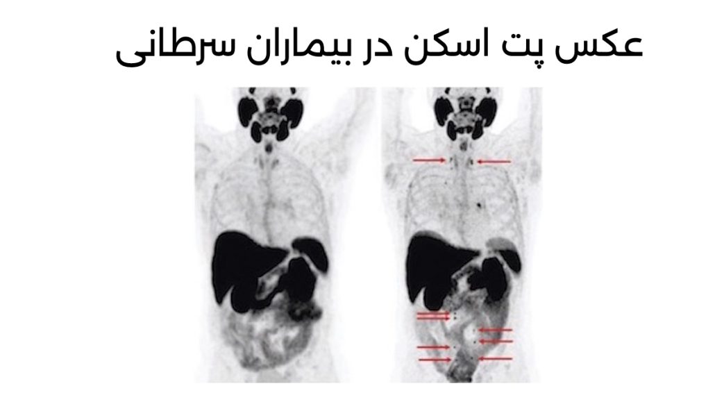 حضور نقاط پررنگ در جواب پت اسکن بیماران سرطانی 